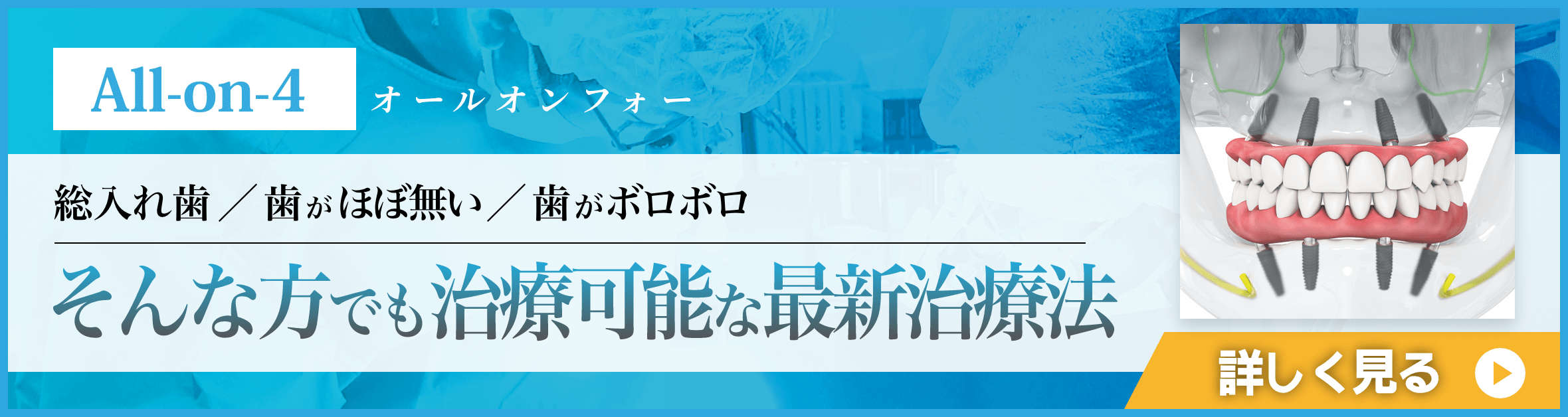 All-on-4(オールオン4)バナー
