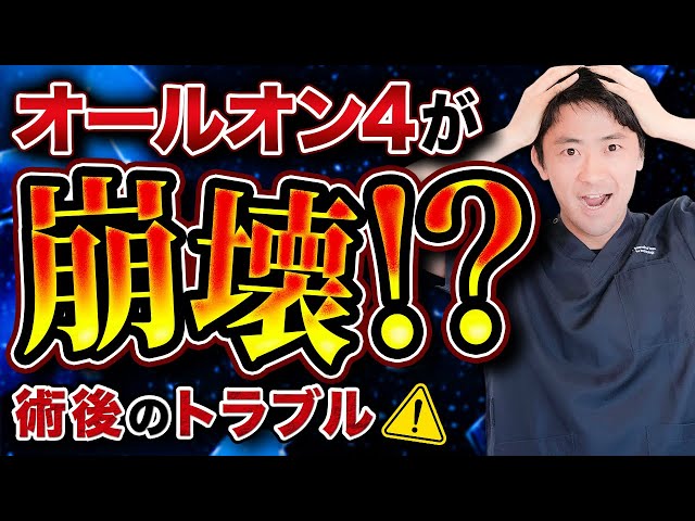 【オールオン4のトラブル！？】オールオン4は入れて終わりじゃない！インプラントの専門家が徹底解説サムネイル