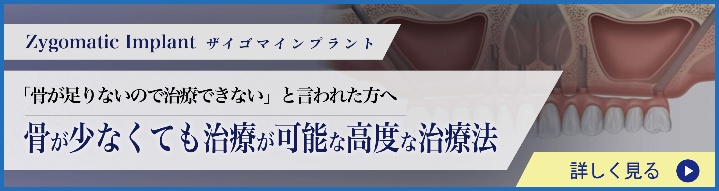 ザイゴマインプラントバナー