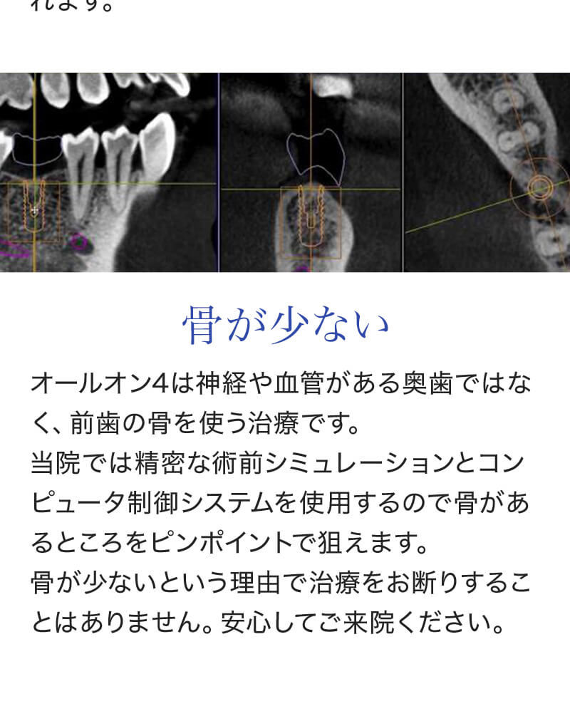 残っている歯がほとんどない総入れ歯の方 - 骨が少ない